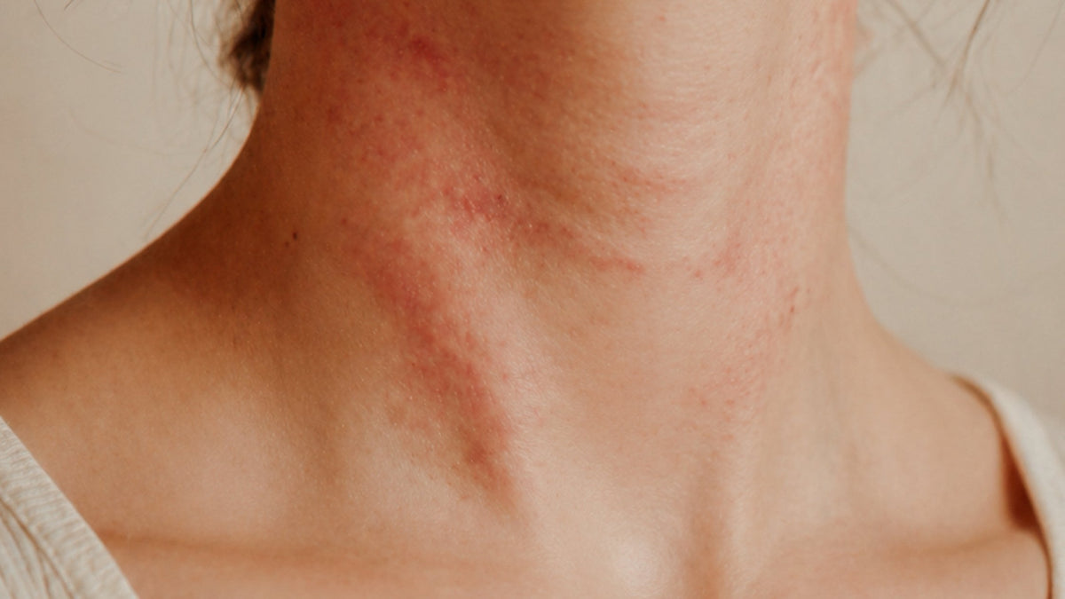 Sí, la manteca de karité también es perfecta para aliviar la dermatitis atópica