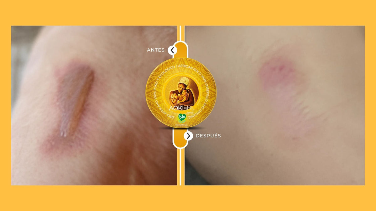 Manteca de karité pura para aliviar quemaduras solares y regenerar la piel