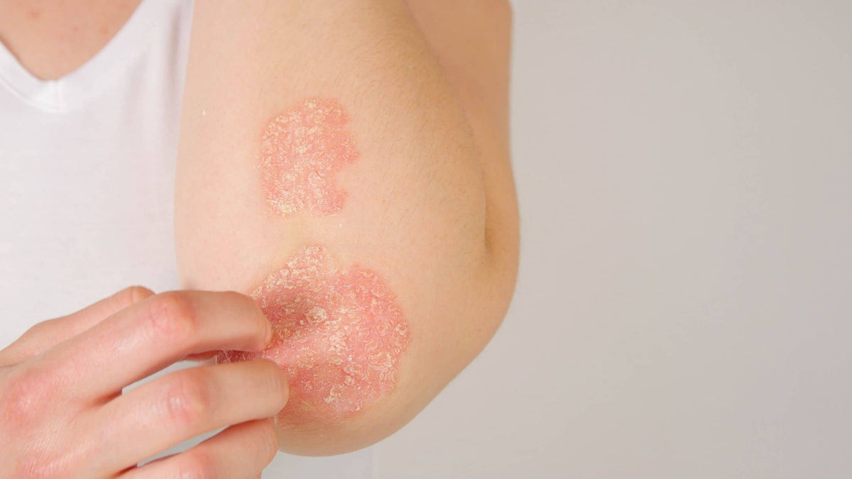 Cómo mejorar la piel con psoriasis con consejos, cuidados y remedios efectivos