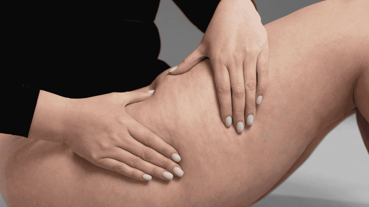 Cómo eliminar la piel de naranja y combatir la celulitis de forma efectiva