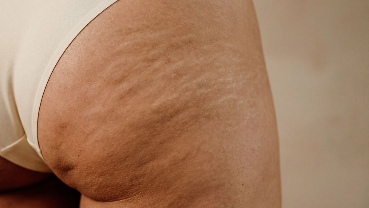 Cuerpo áspero y textura en la piel: causas y cómo tratarla