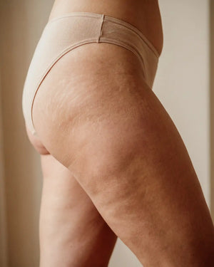 Celulitis o Estrías